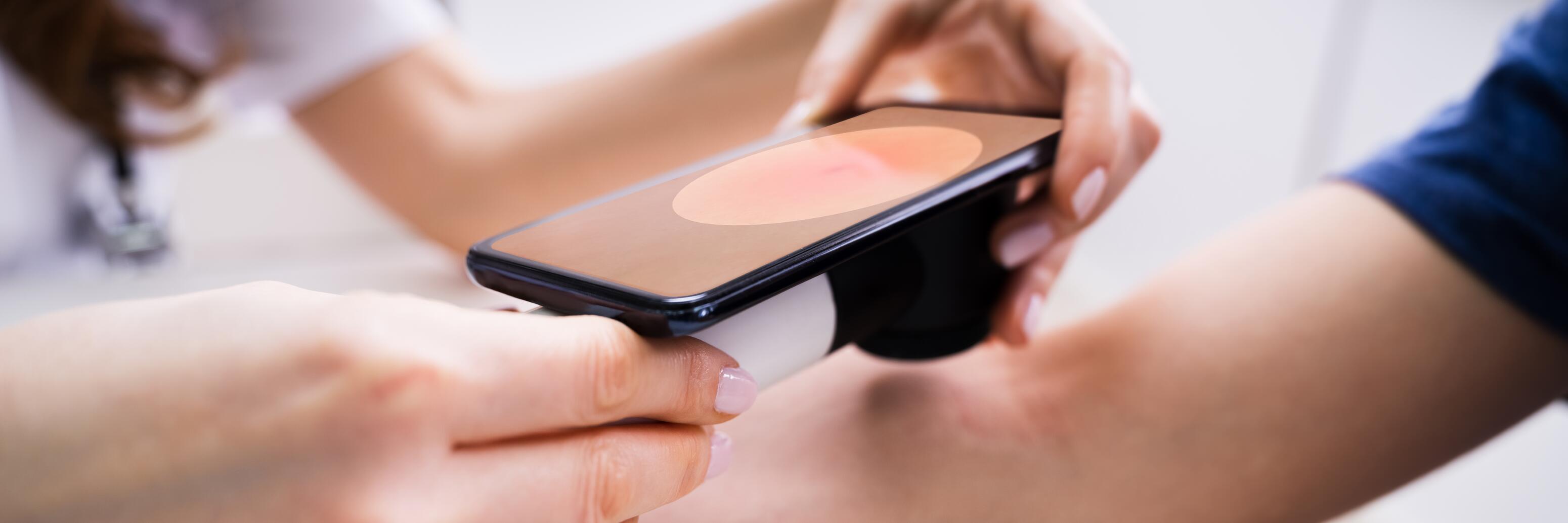 soulager démangeaisons eczéma